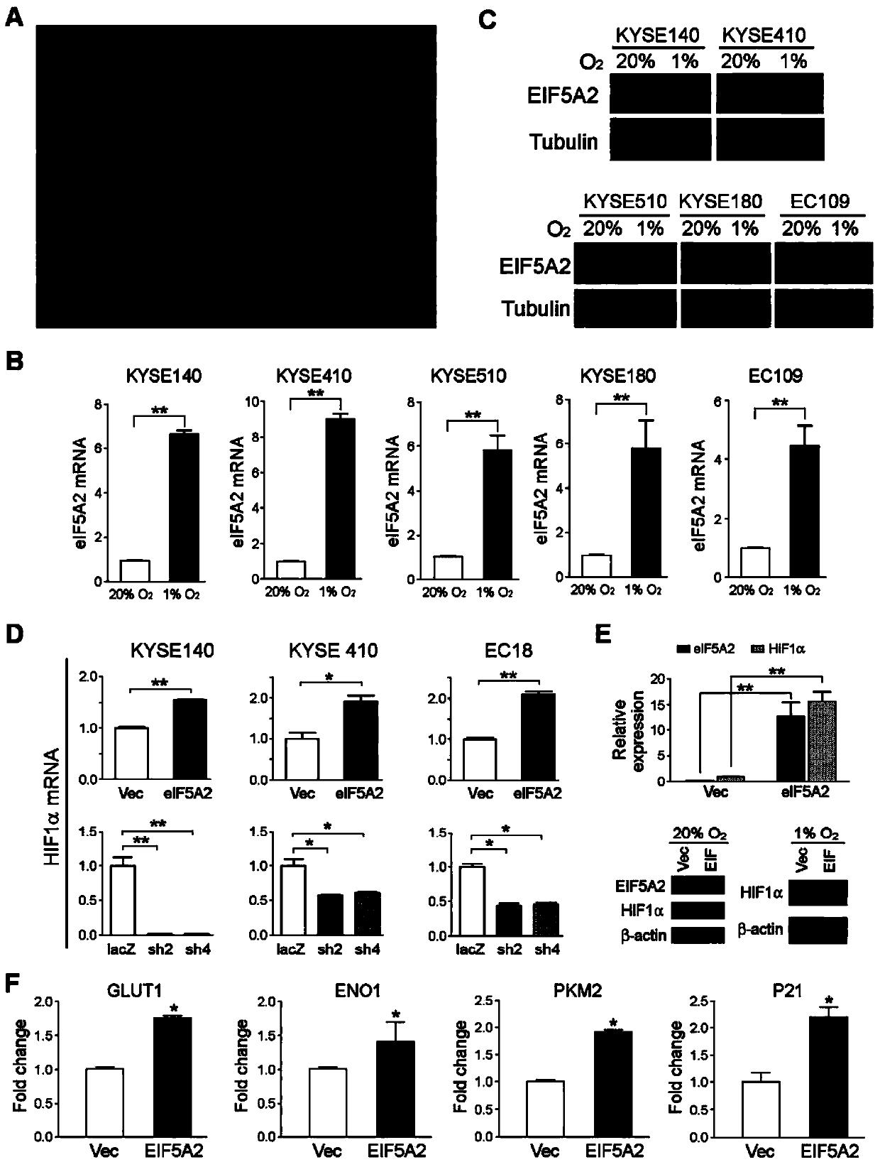 Application of EIF5A2 to preparation of esophageal squamous cell carcinoma prognosis reagent