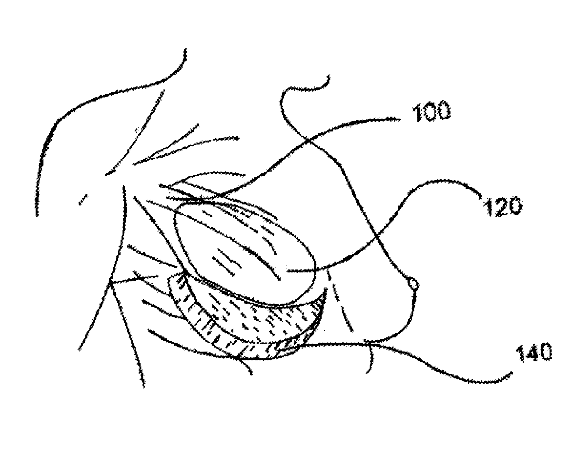 Surgical attachment device