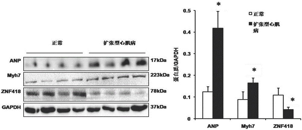 Application of ZNF418 (zinc finger protein 418) to treatment of myocardial hypertrophy