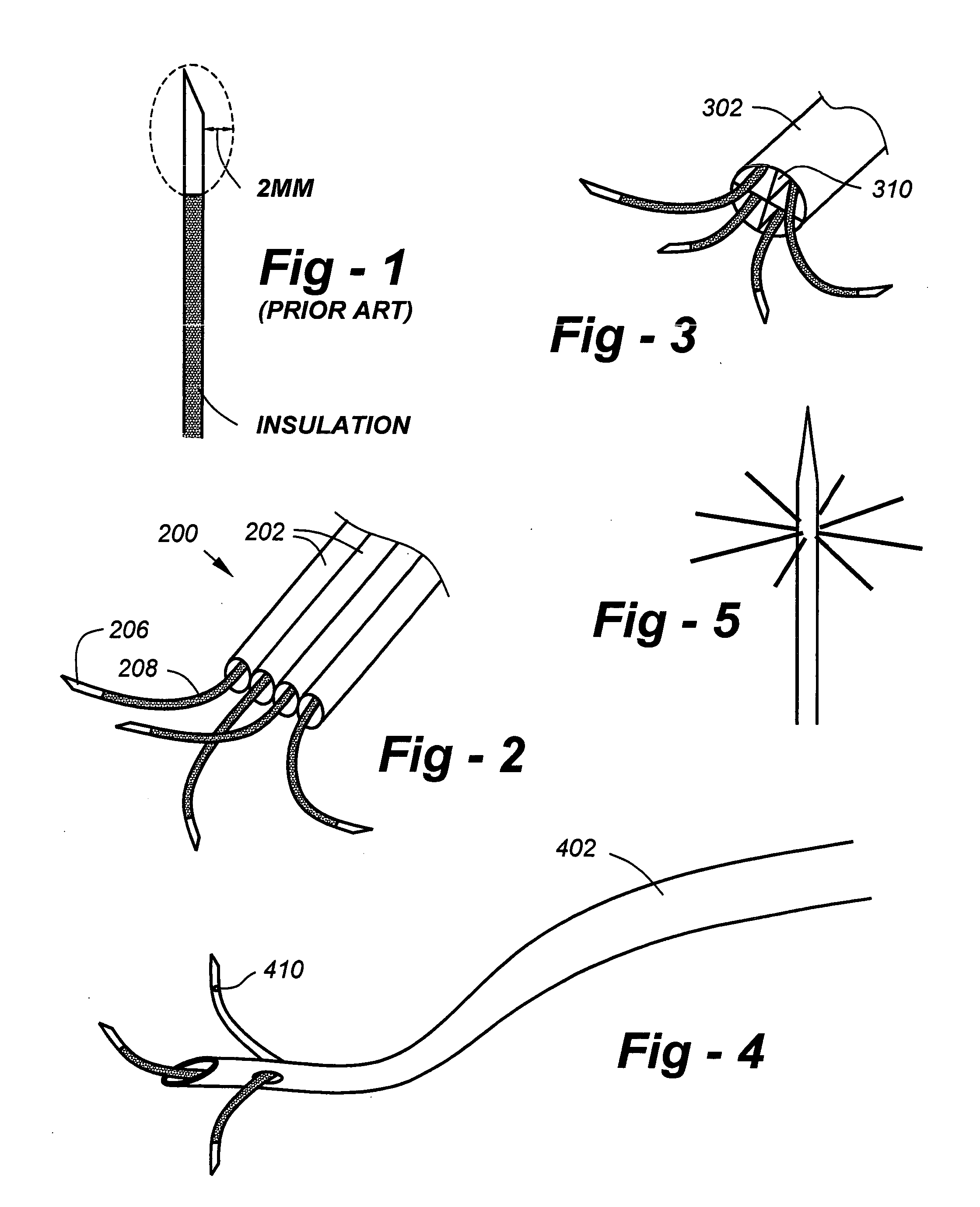 Enhancing the effectiveness of medial branch nerve root RF neurotomy