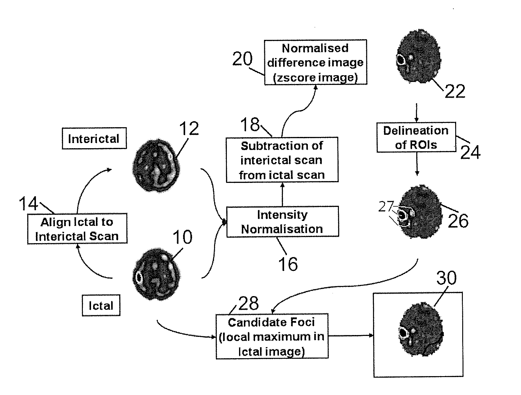 Method for localization of an epileptic focus in neuroimaging