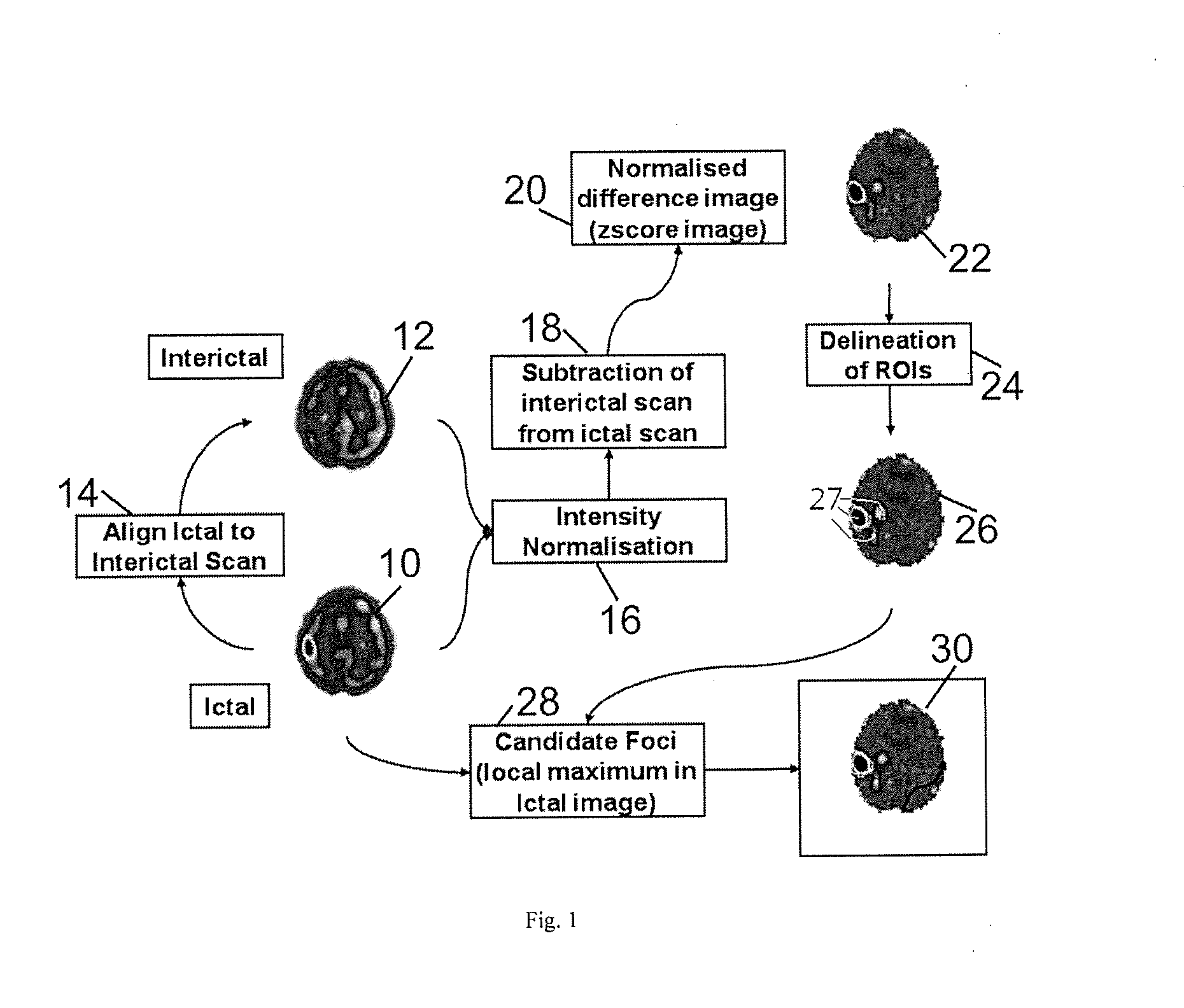 Method for localization of an epileptic focus in neuroimaging