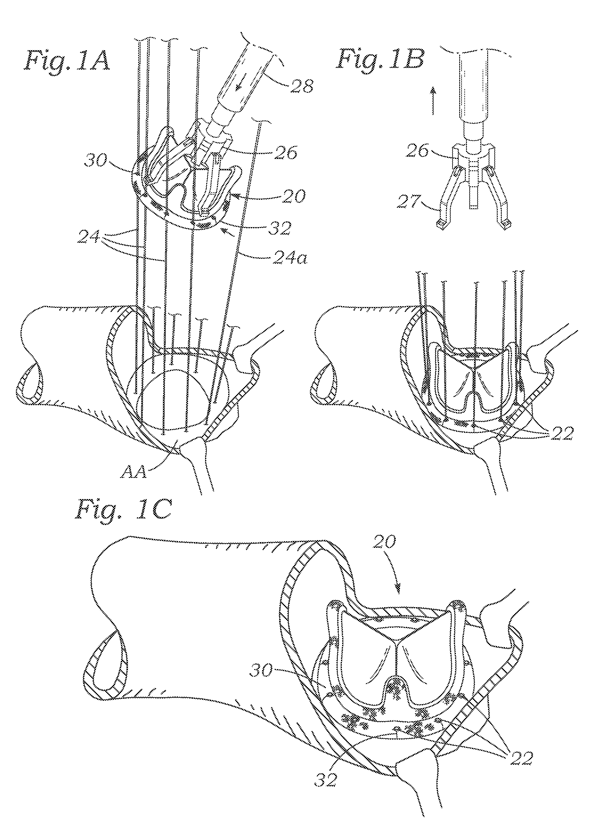 Cardiac implant with integrated suture fasteners