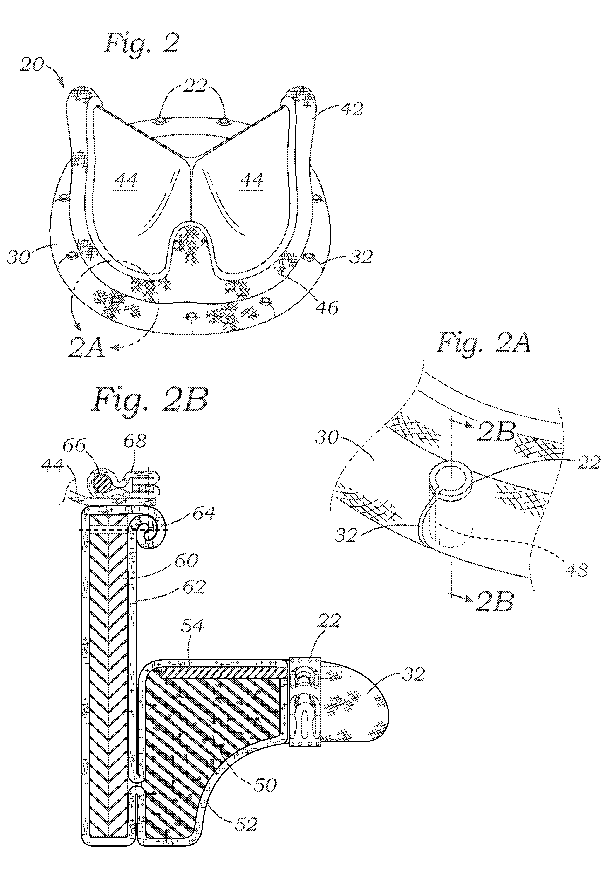 Cardiac implant with integrated suture fasteners