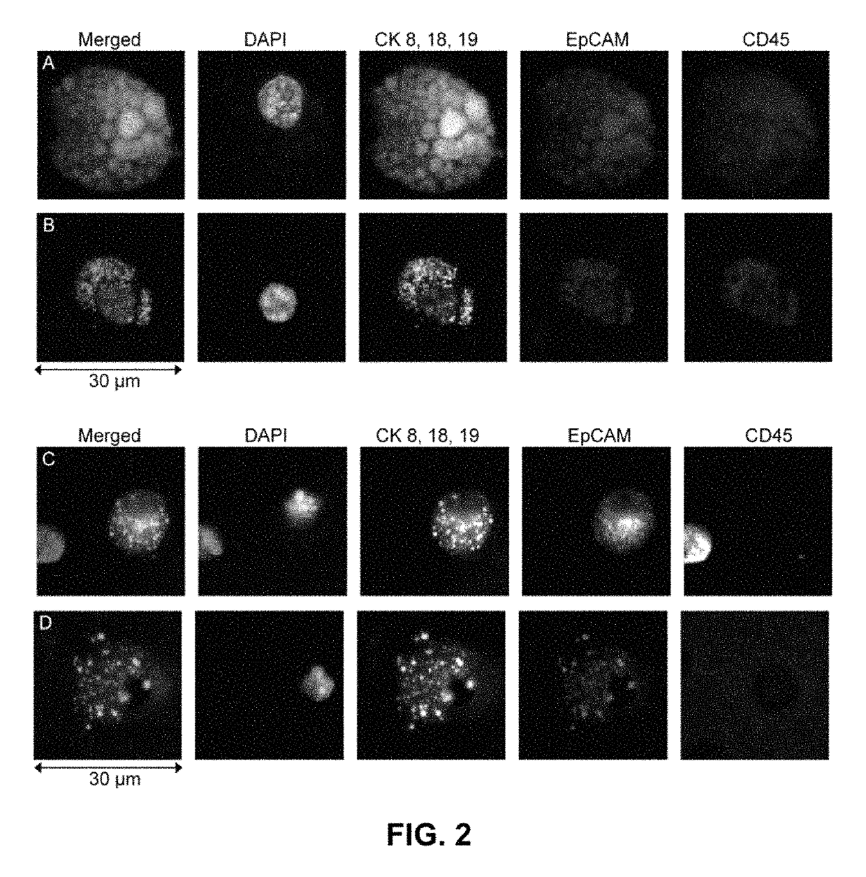 Capture, identification and use of a new biomarker of solid tumors in body fluids