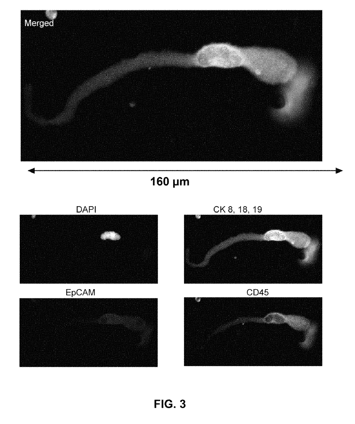 Capture, identification and use of a new biomarker of solid tumors in body fluids