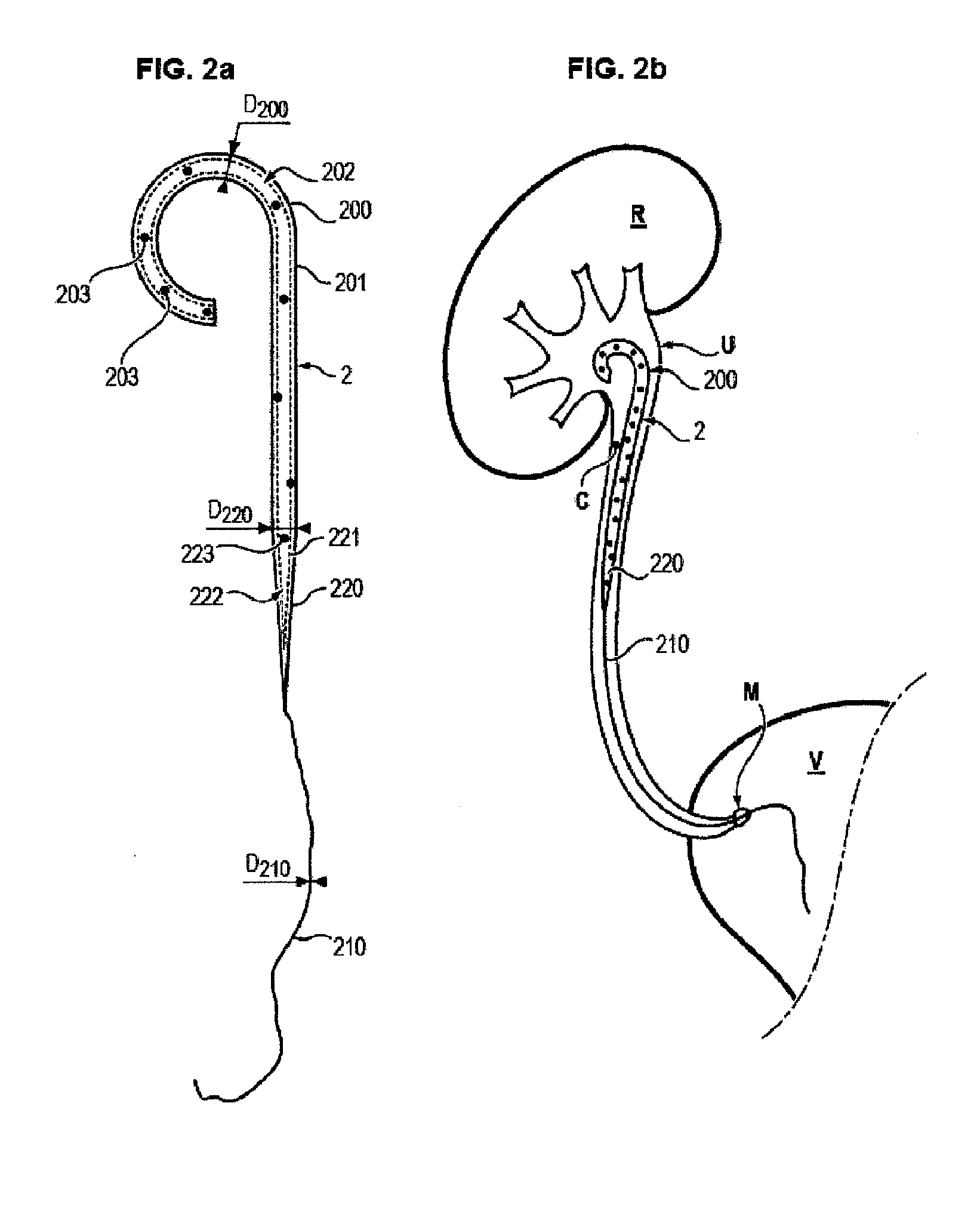 Improved ureteral stent and method for treating urological problems