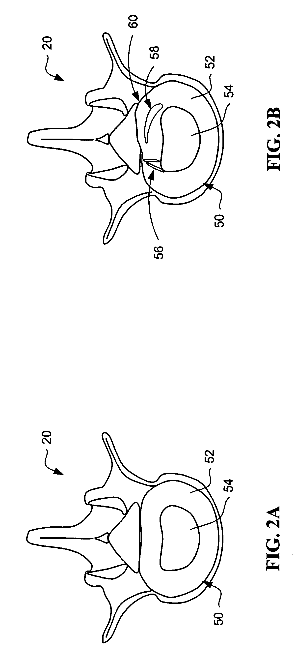 Devices and methods for annular repair of intervertebral discs