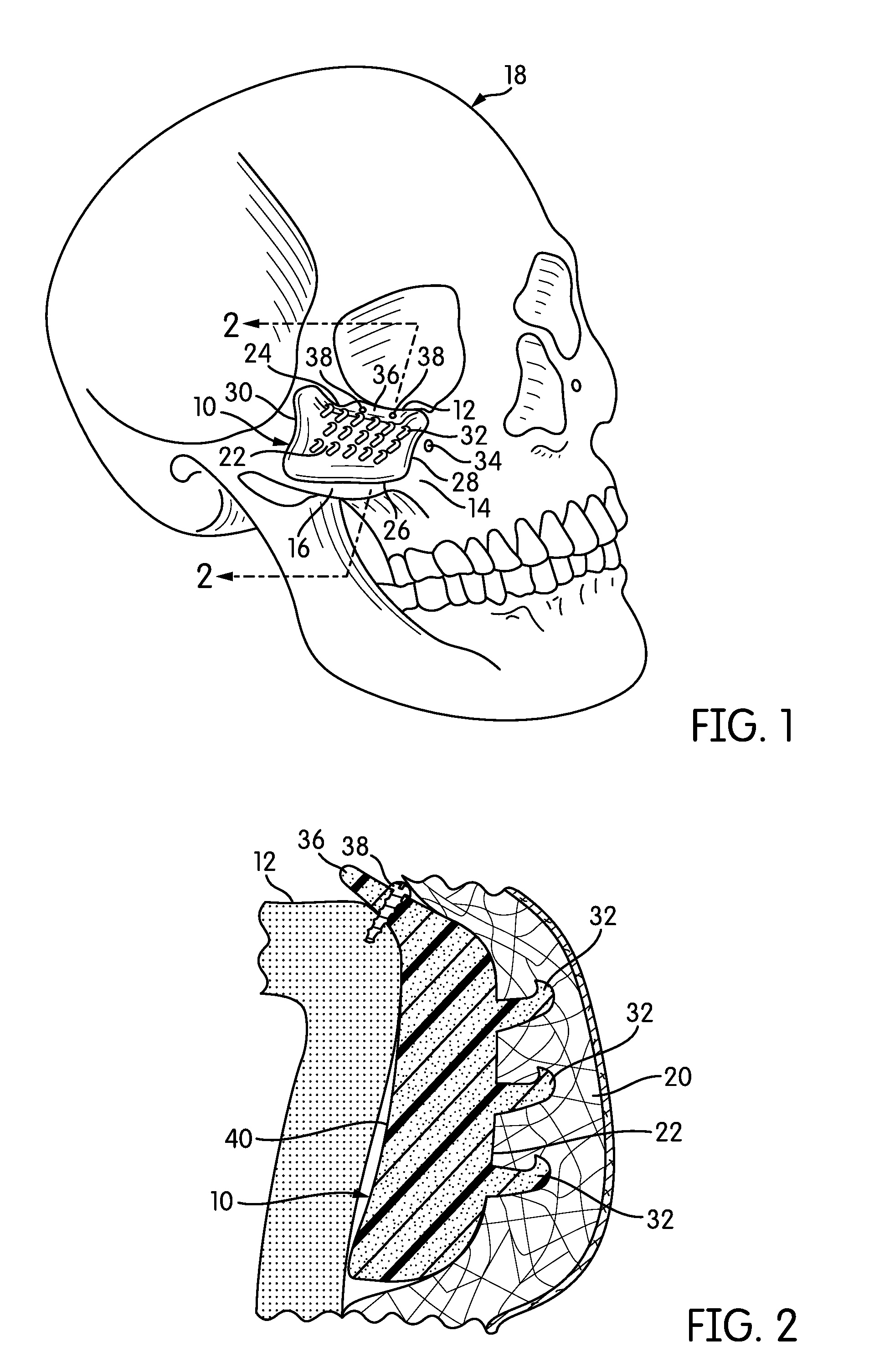 Malar Implant with Dual-Plane Adhesion