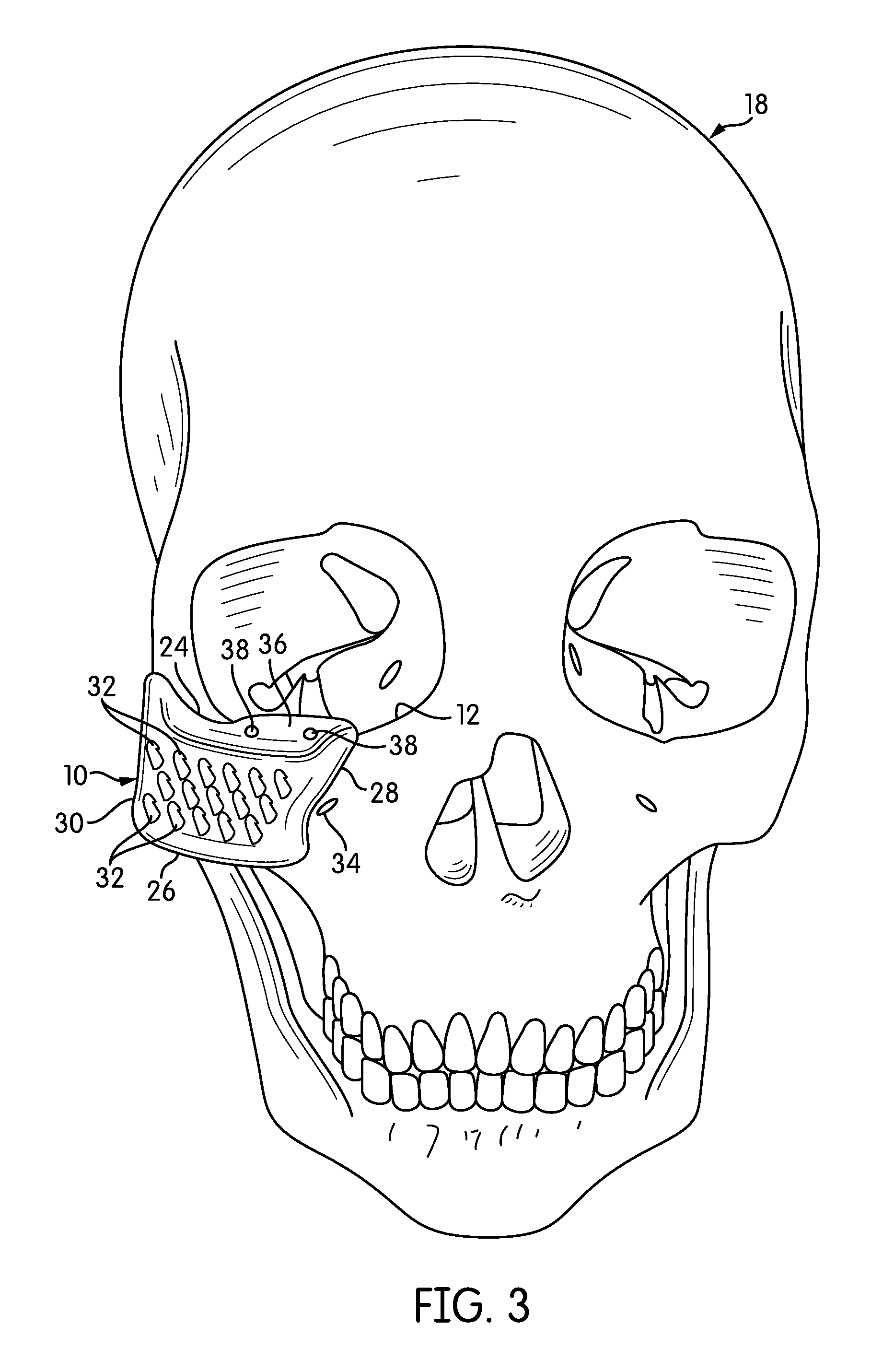 Malar Implant with Dual-Plane Adhesion