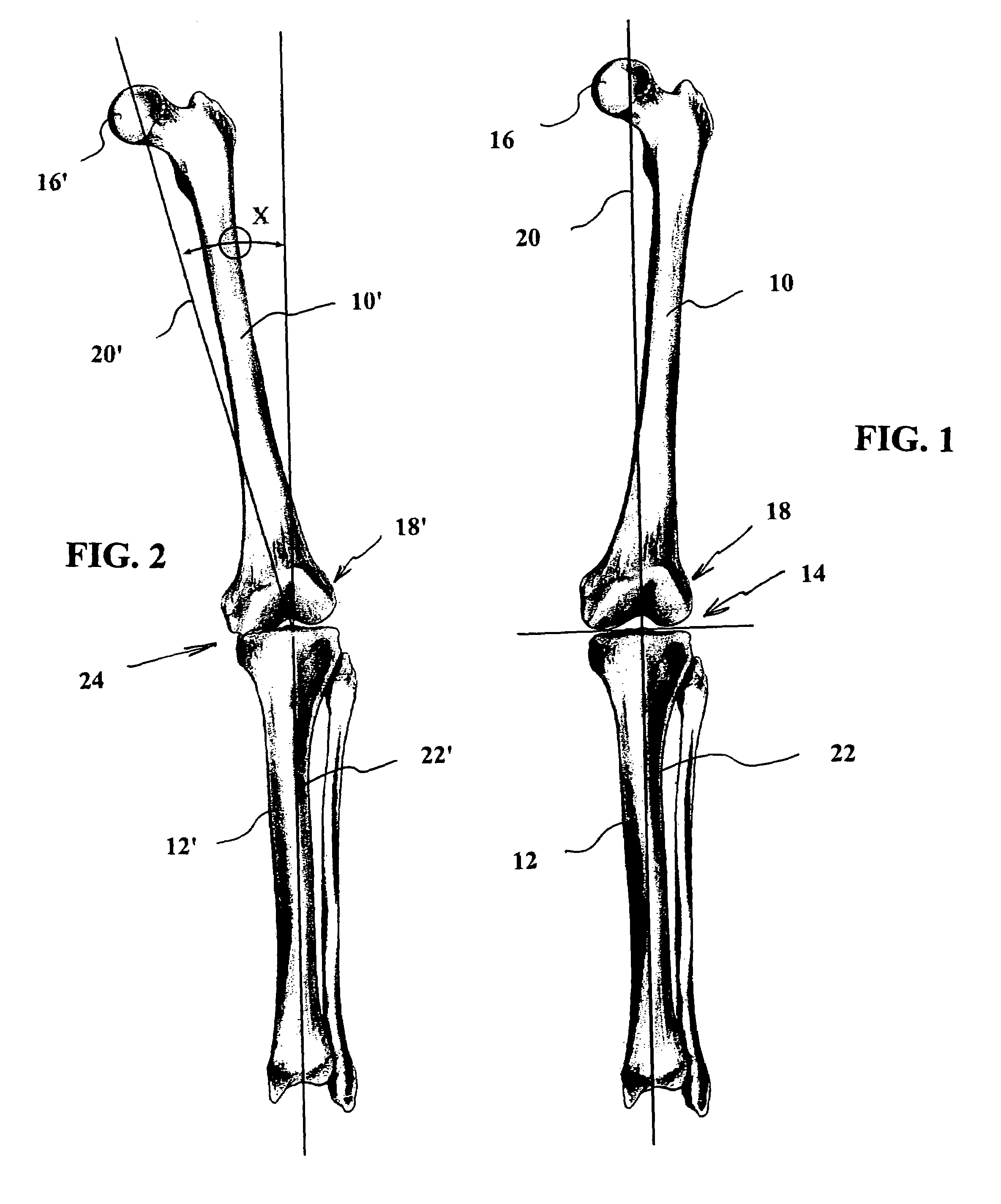 Method and apparatus for achieving correct limb alignment in unicondylar knee arthroplasty