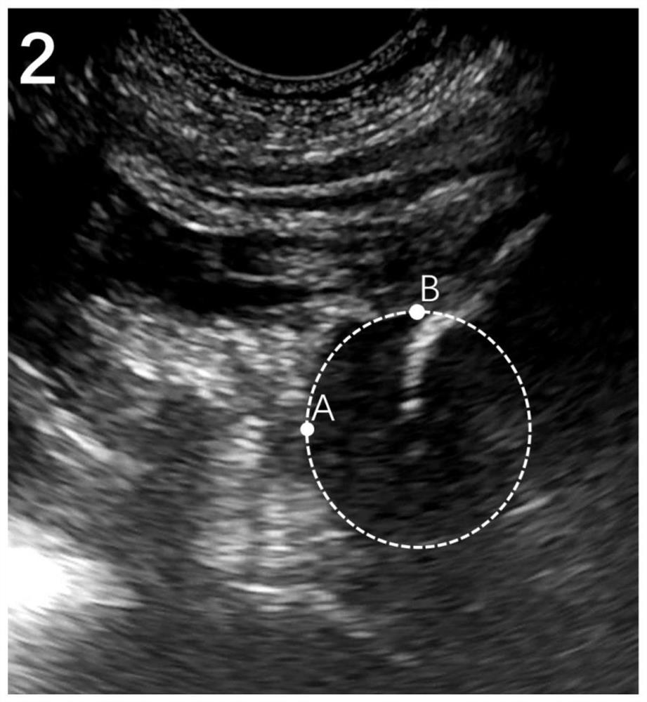 Femoral head localization method, system, device and storage medium in ultrasound image