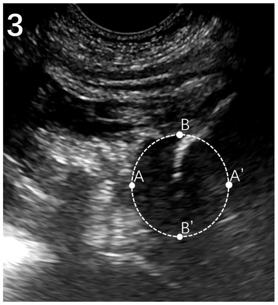 Femoral head localization method, system, device and storage medium in ultrasound image