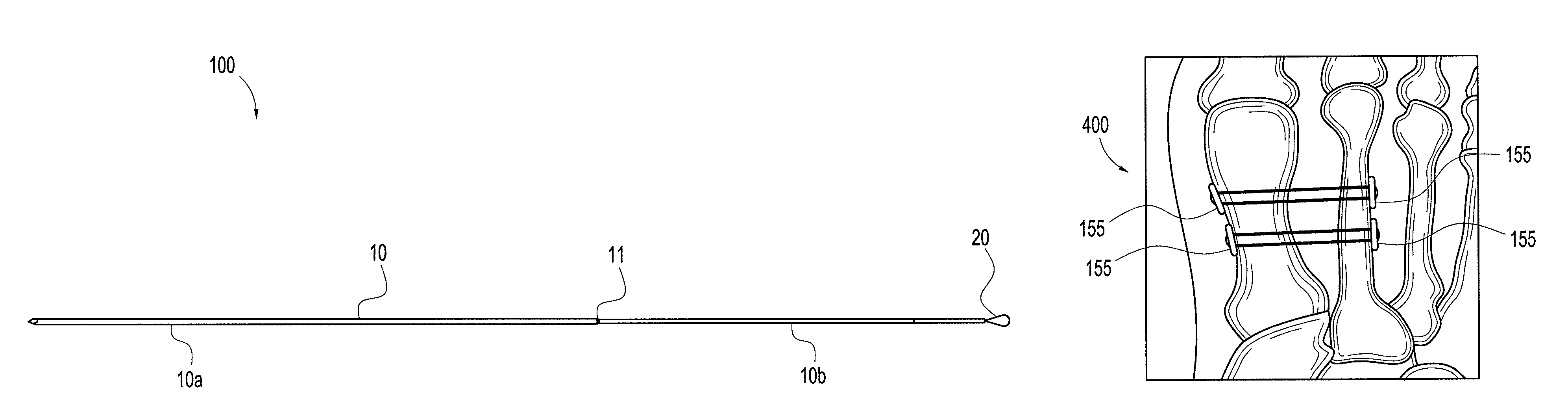 Suture passing K-wire