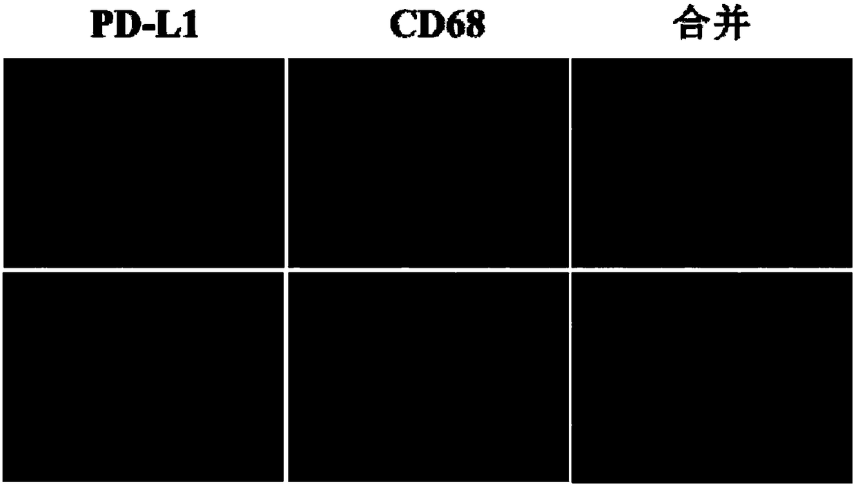 Double-antibody combined fluorescence detection kit for liver cancer resection postoperative prognosis