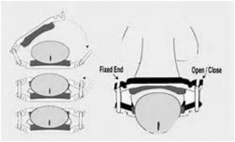 Novel urethral clamp for treating male urinary incontinence