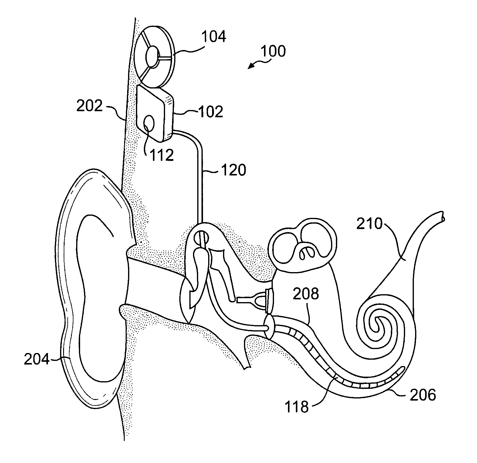 Temperature regulated implant