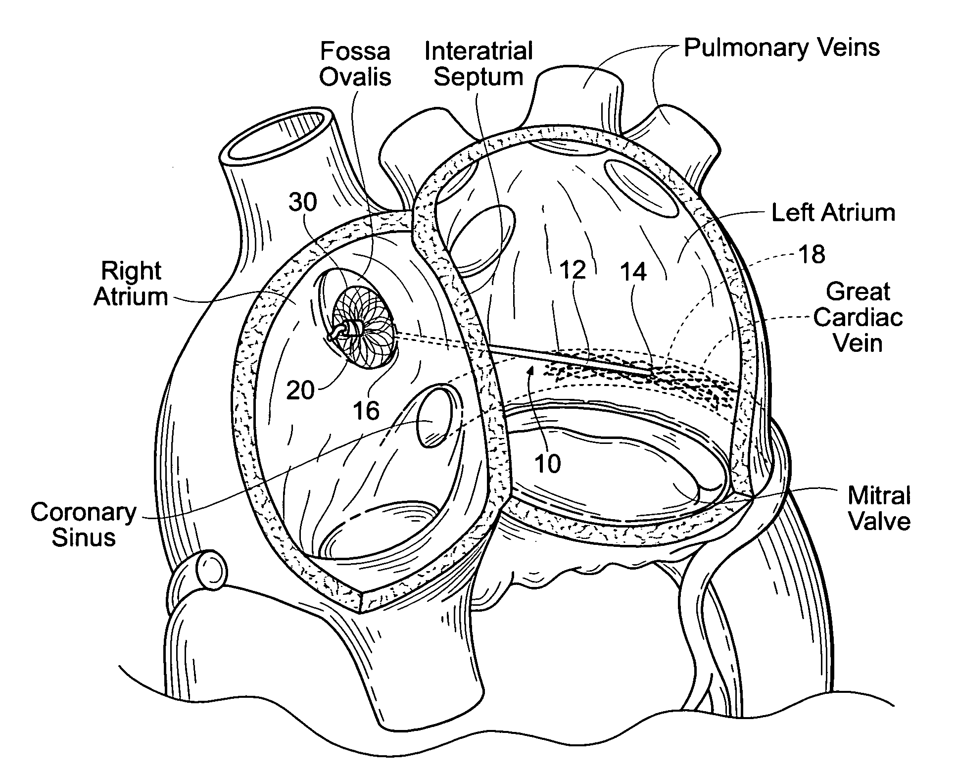 Devices, systems, and methods for reshaping a heart valve annulus