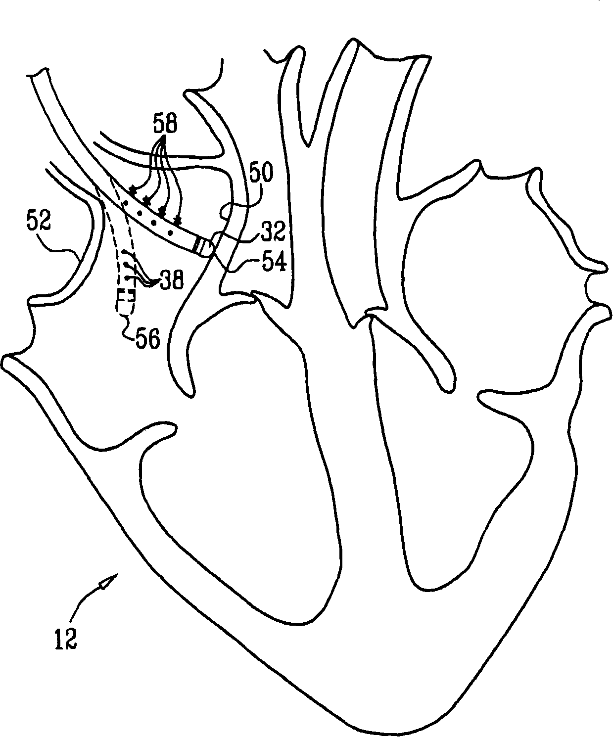 Mapping of complex fractionated atrial electrogram