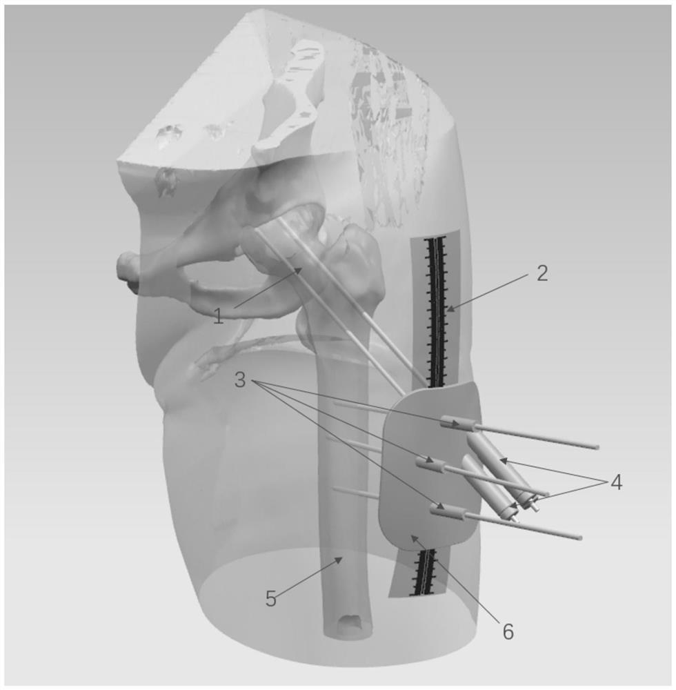 Method for percutaneous positioning of internal fixation screw channel of femoral neck fracture screw