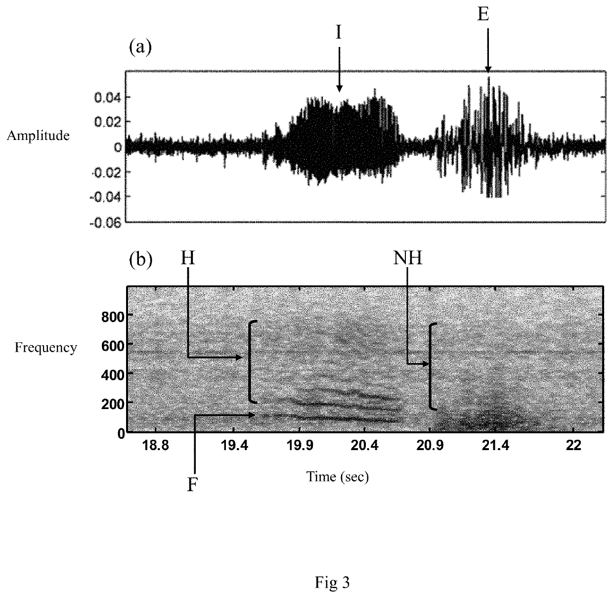 Bed set for inhibition obstructive sleep apnea