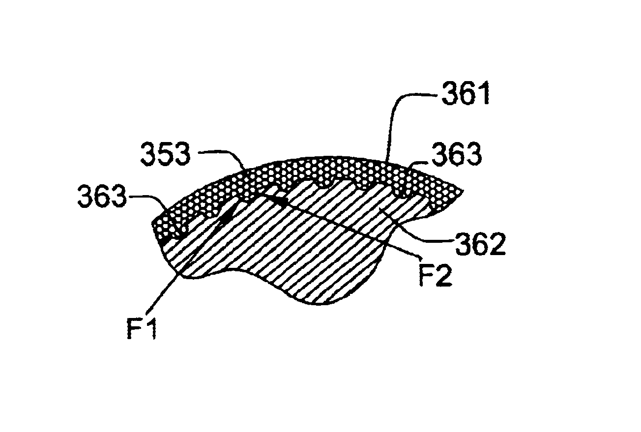 Prosthetic joint component having at least one sintered polycrystalline diamond compact articulation surface and substrate surface topographical features in said polycrystalline diamond compact