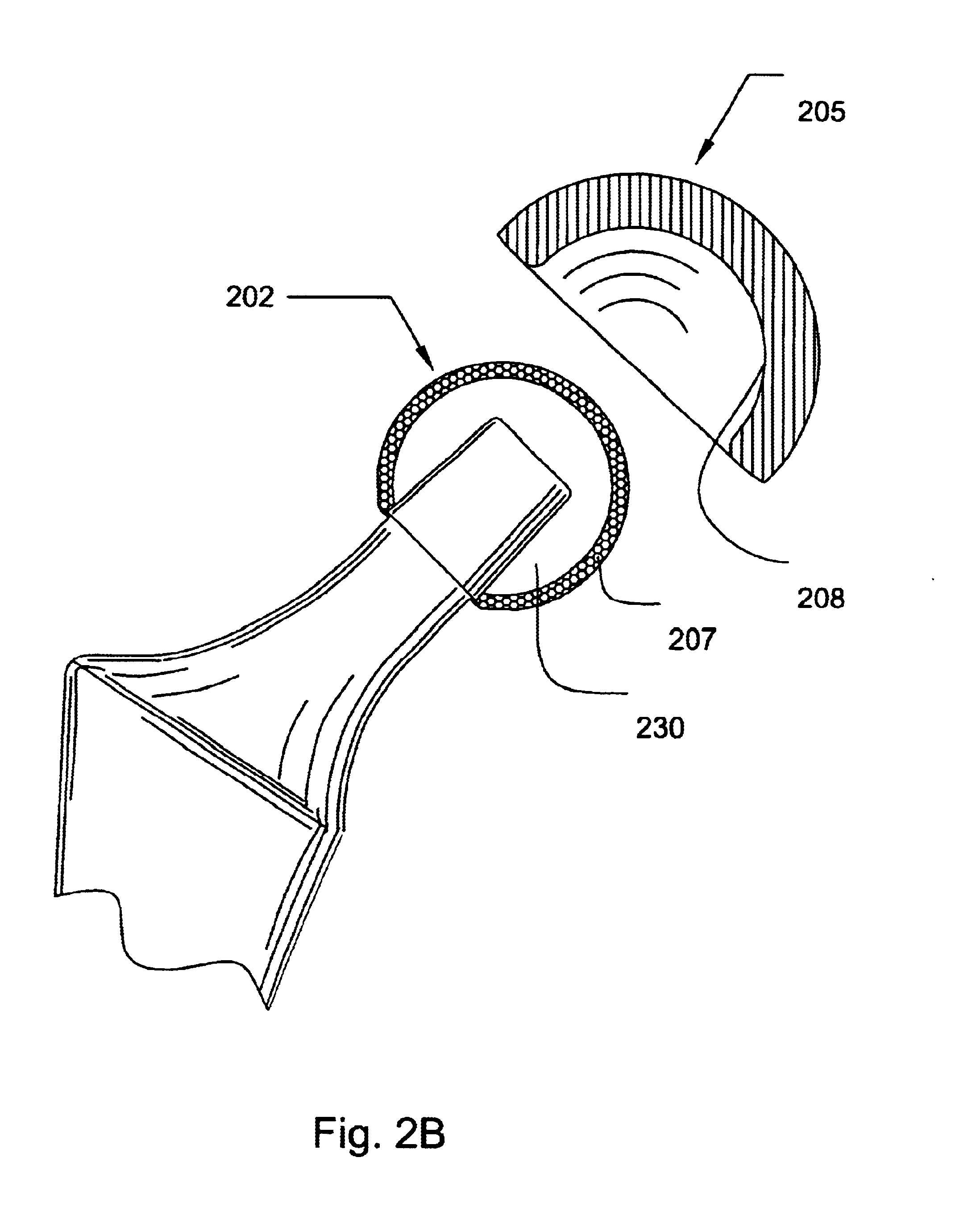 Prosthetic joint component having at least one sintered polycrystalline diamond compact articulation surface and substrate surface topographical features in said polycrystalline diamond compact