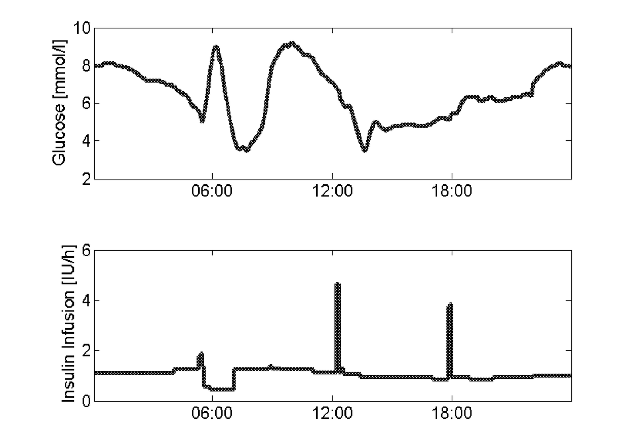 Medical arrangements and a method for determining parameters related to insulin therapy, predicting glucose values and for providing insulin dosing recommendations