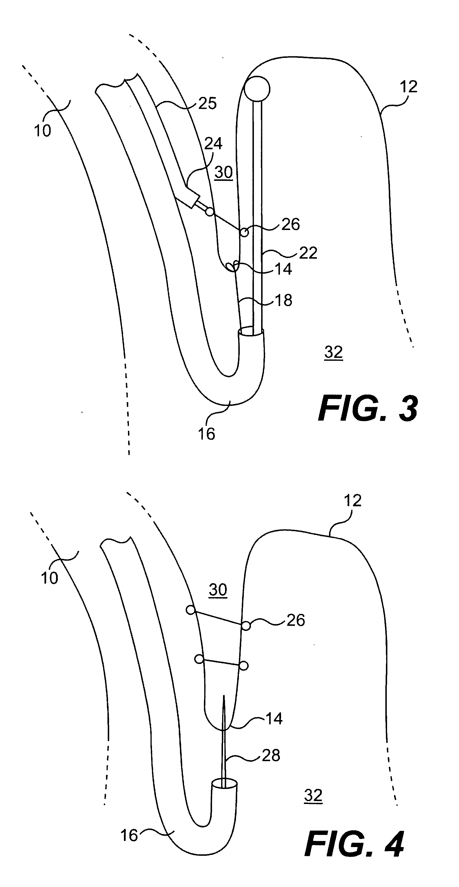 Method for performing endoluminal fundoplication and apparatus for use in the method