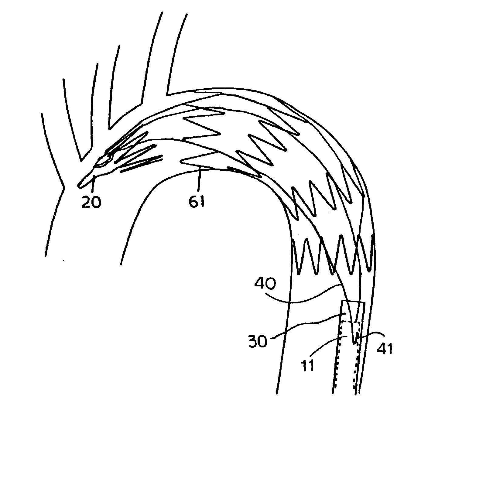 Stent Graft Indwelling Device And Fixed Chip