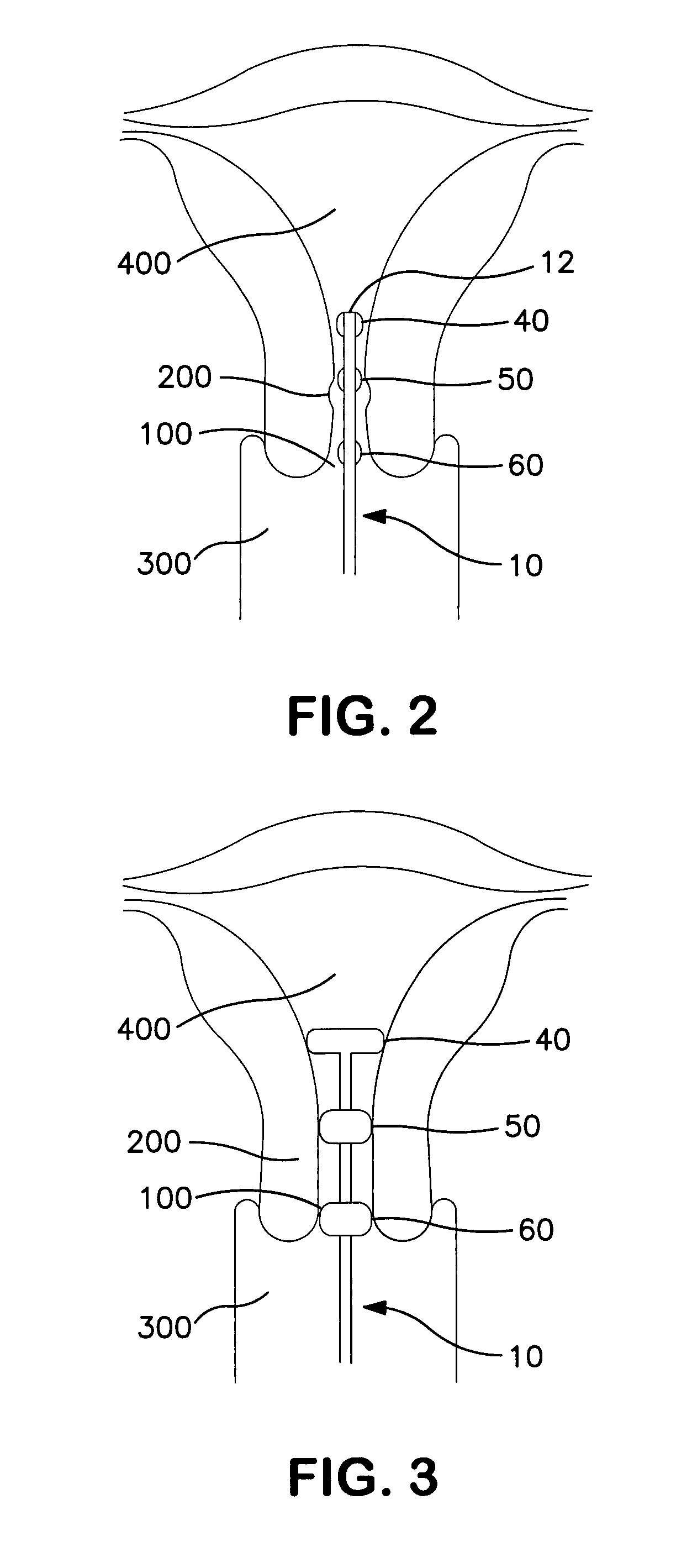 Fluid-filled cervical dilator