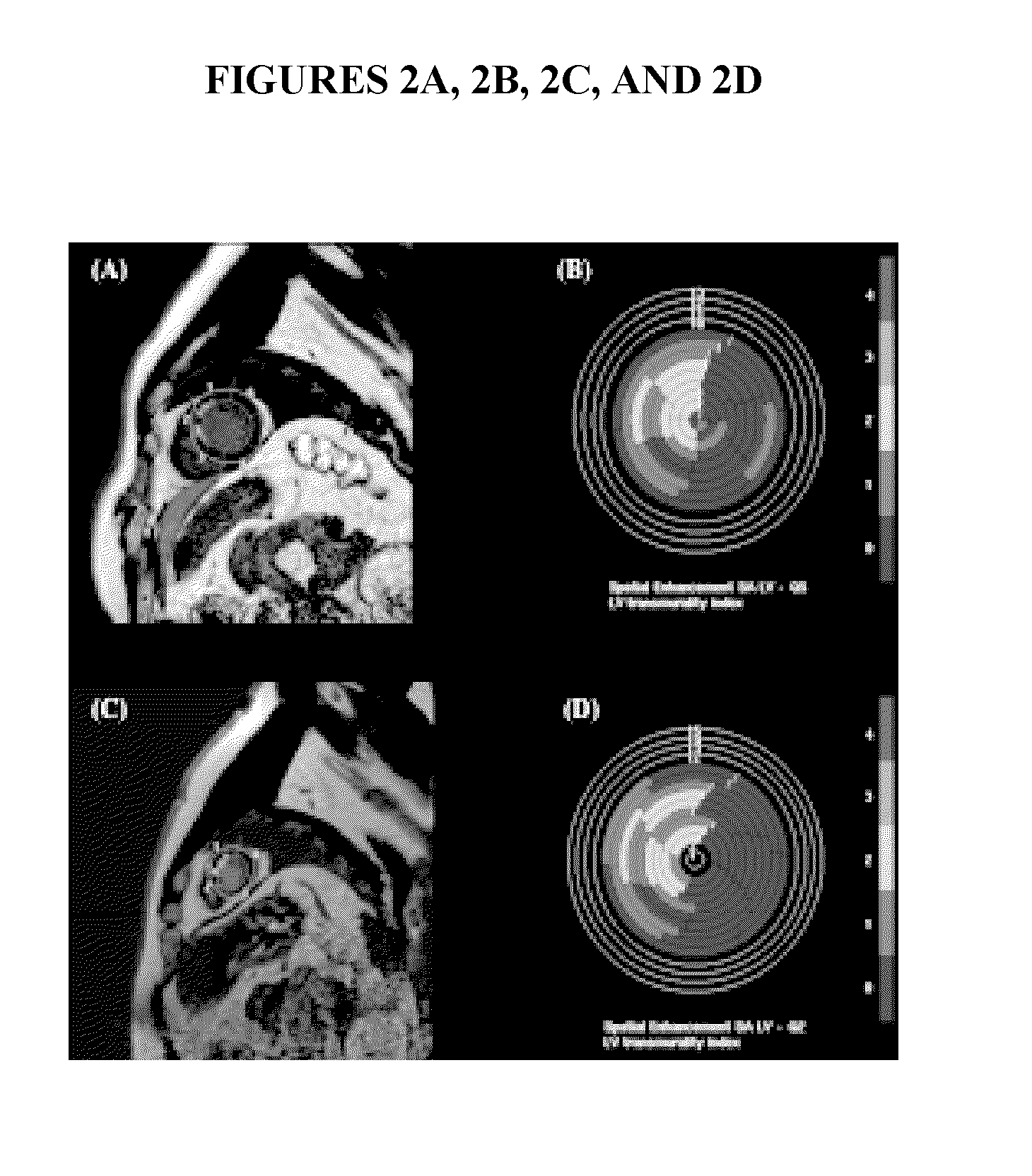 Rapid infusion of autologous bone marrow derived stem cells