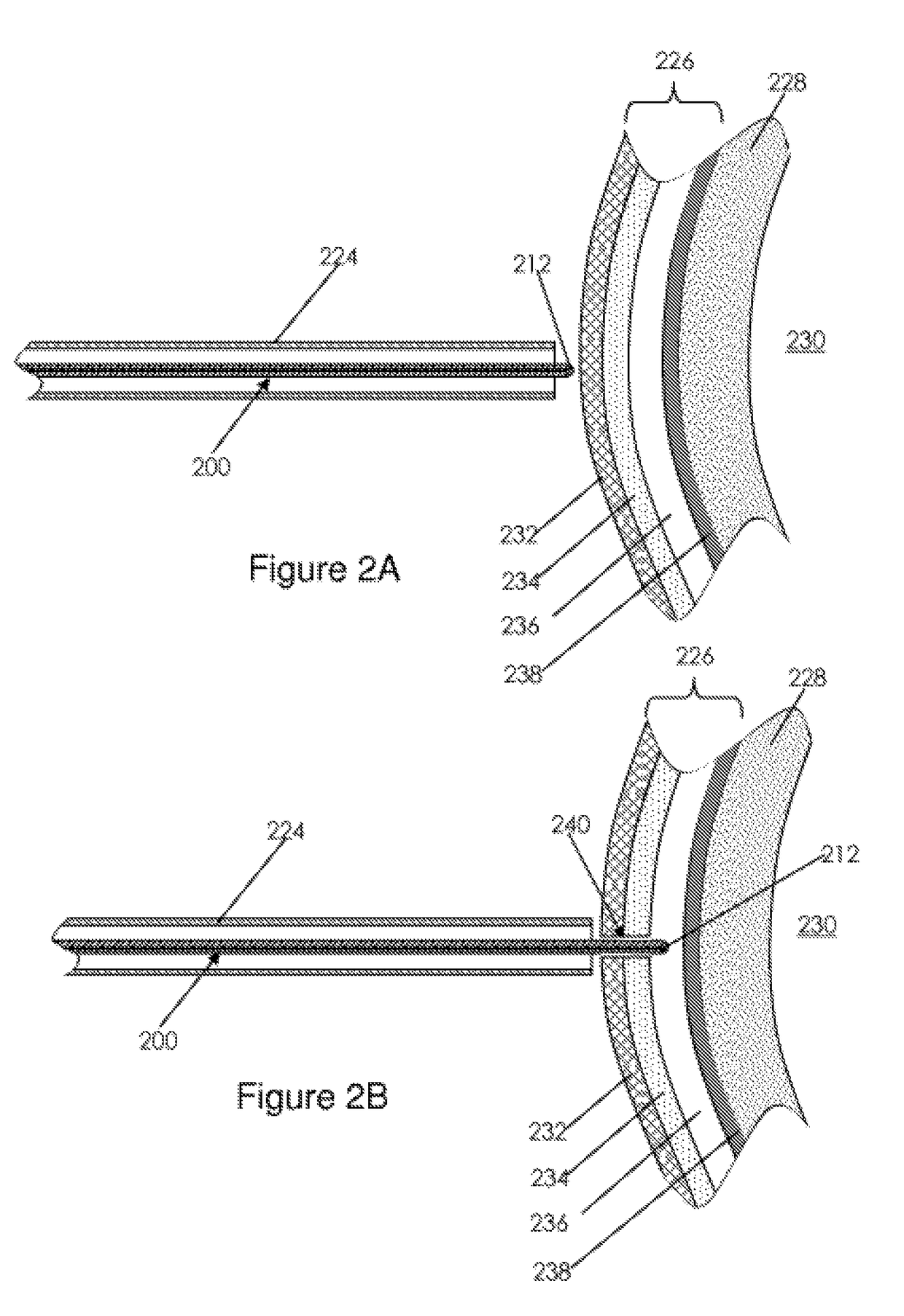 Electrosurgical Pericaridial Puncture