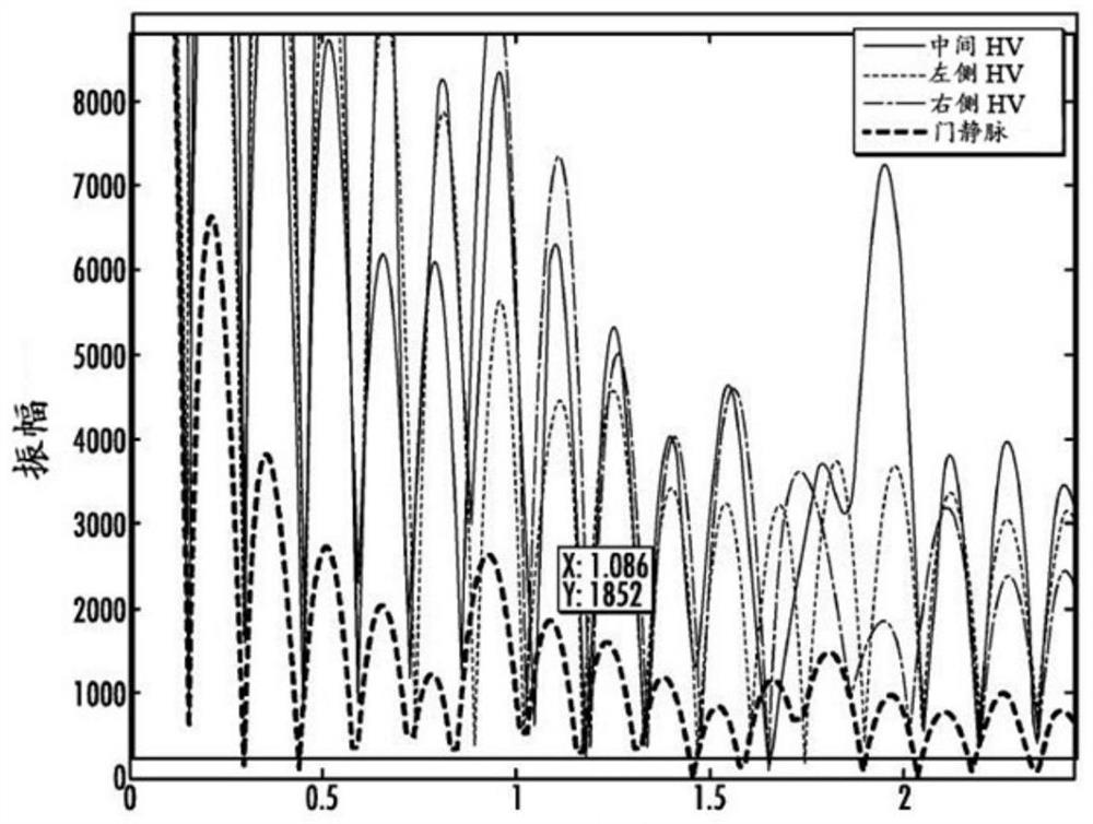 Liver hemodynamic detection device based on multiple hepatic vein oscillograms