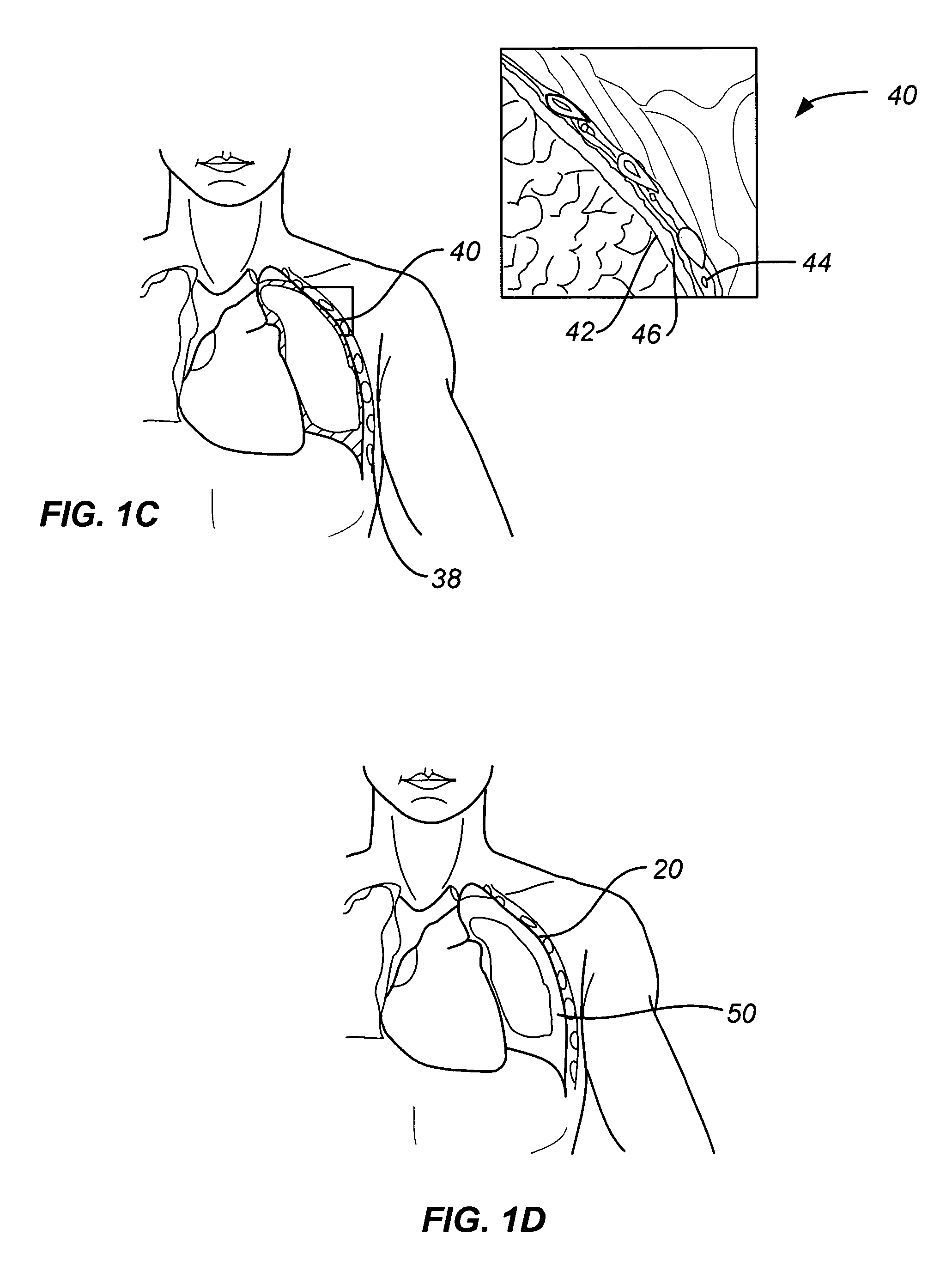 Steerable device for accessing a target site and methods