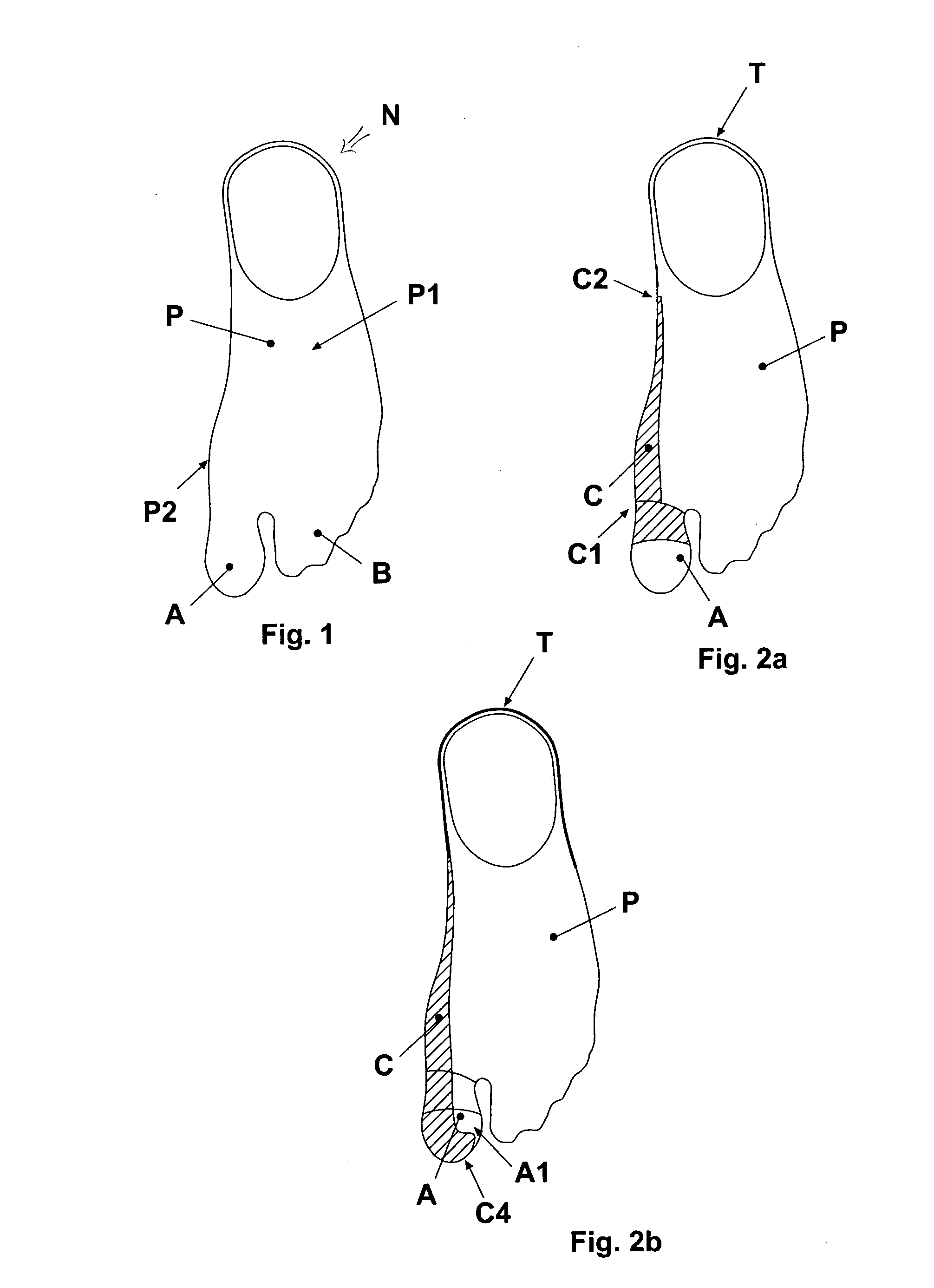 Reinforced stocking or sock for the prevention and/or treatment of hallux valgus