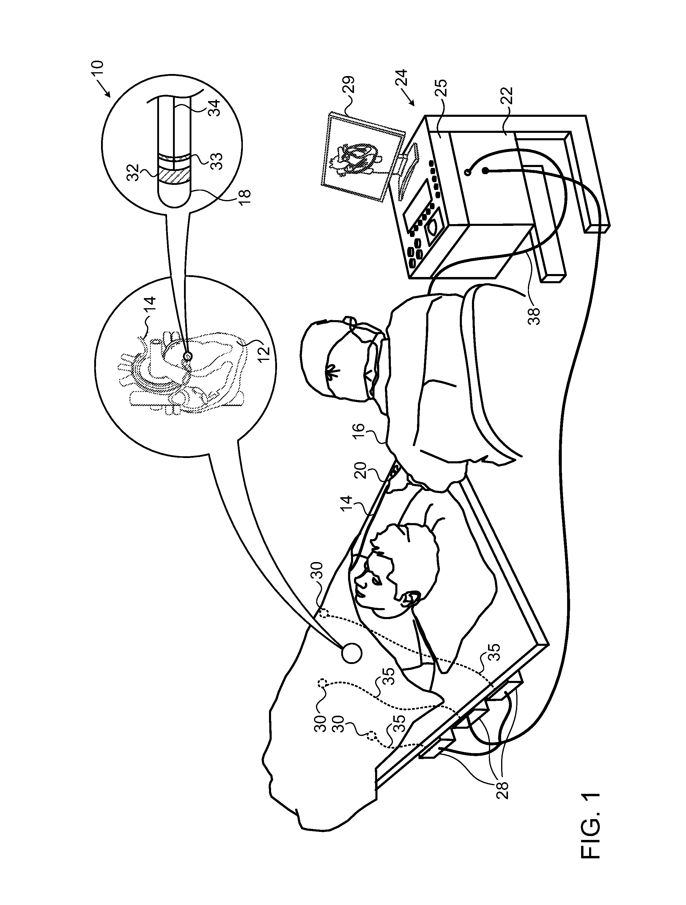 Machine learning in determining catheter electrode contact