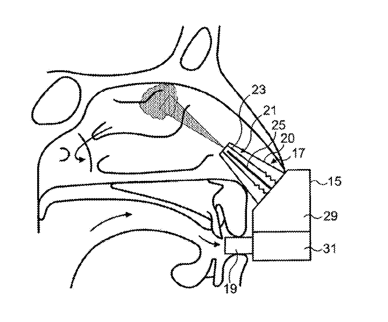 Intranasal administration