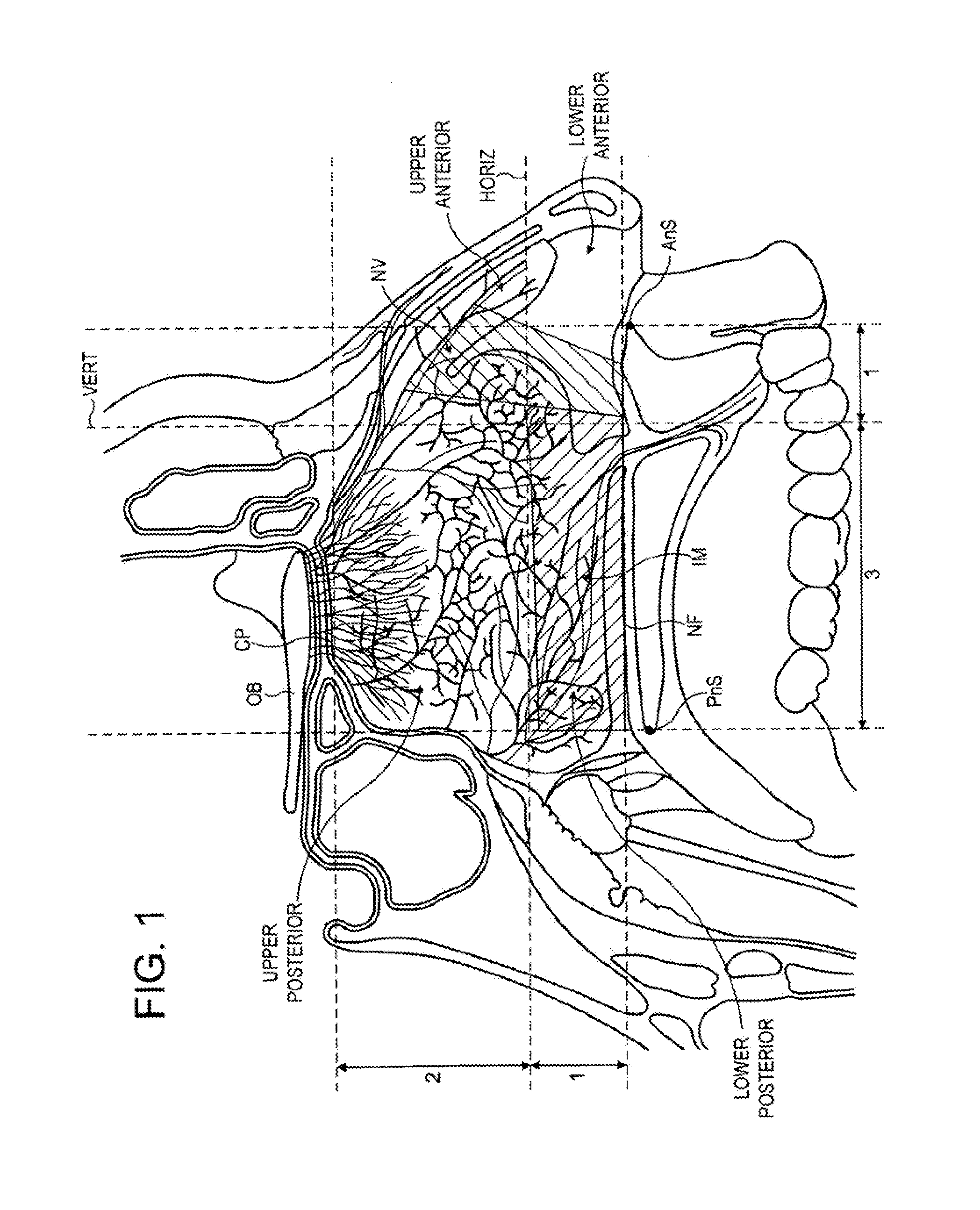 Intranasal administration