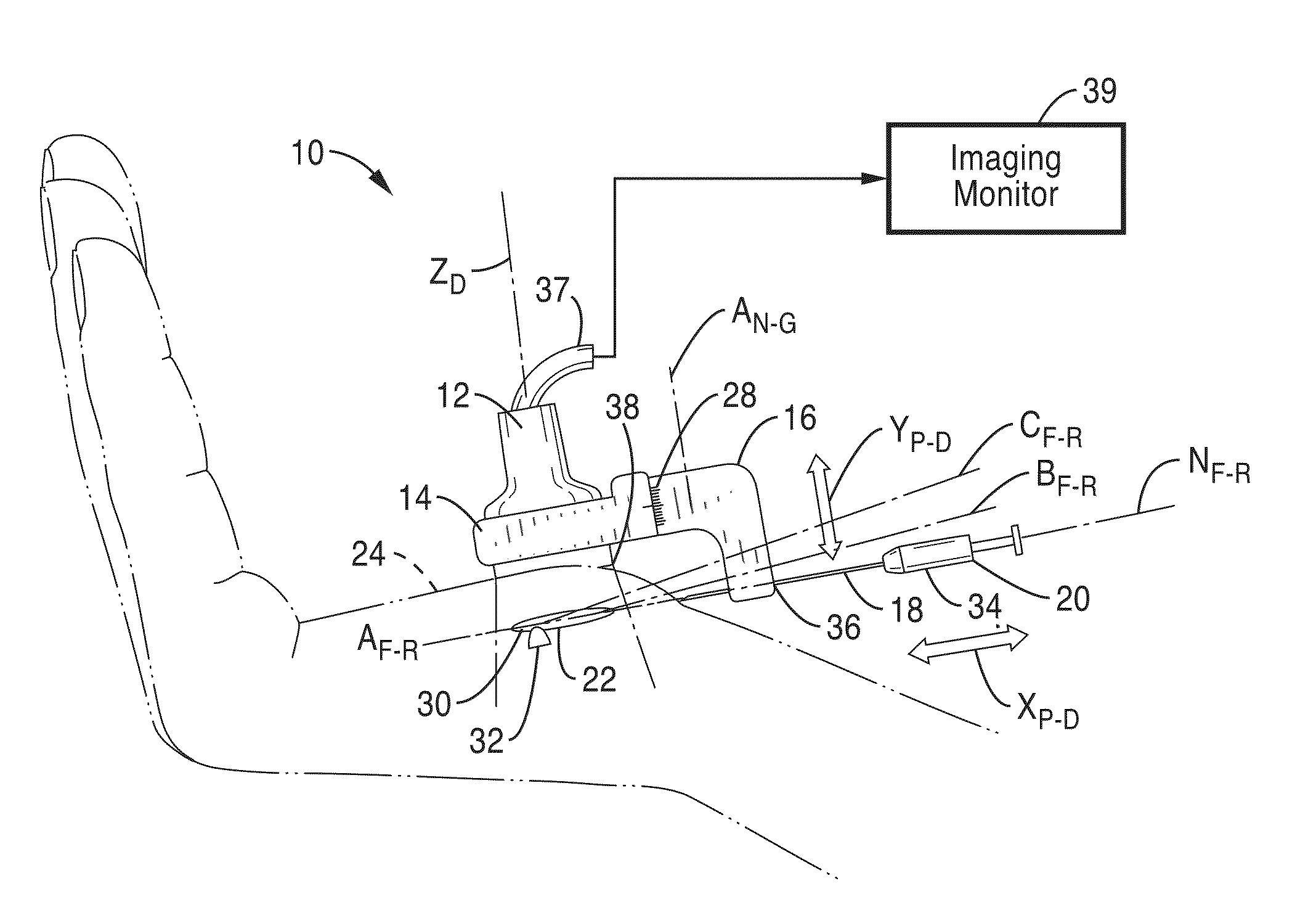 Treatment of carpal tunnel syndrome by injection of the flexor retinaculum