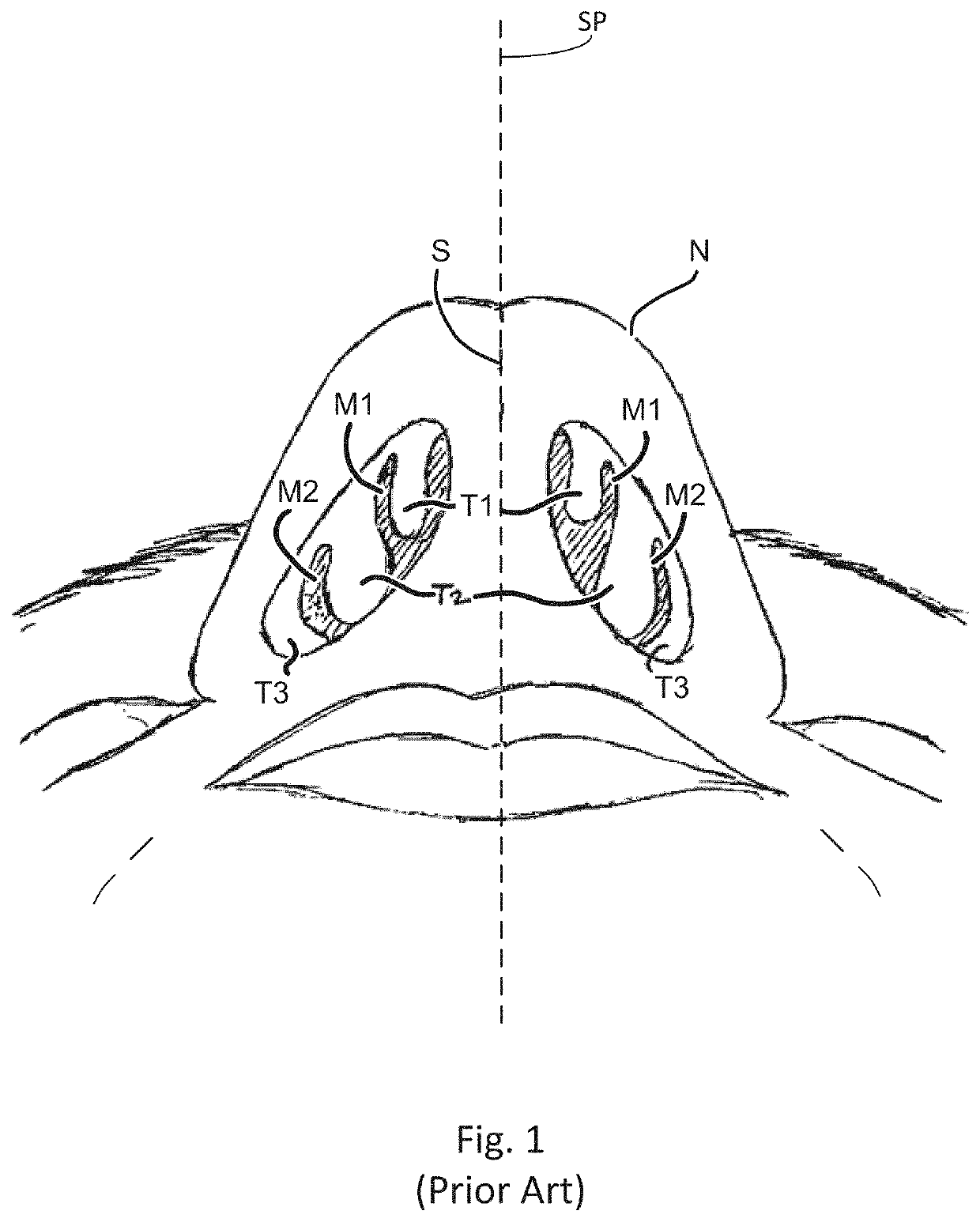 Devices and methods for treating a lateral surface of a nasal cavity