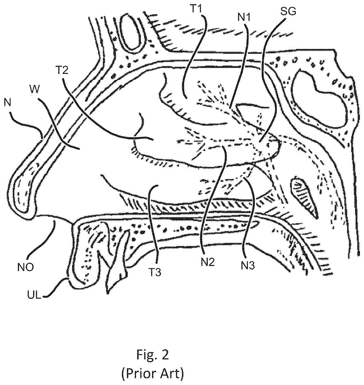 Devices and methods for treating a lateral surface of a nasal cavity