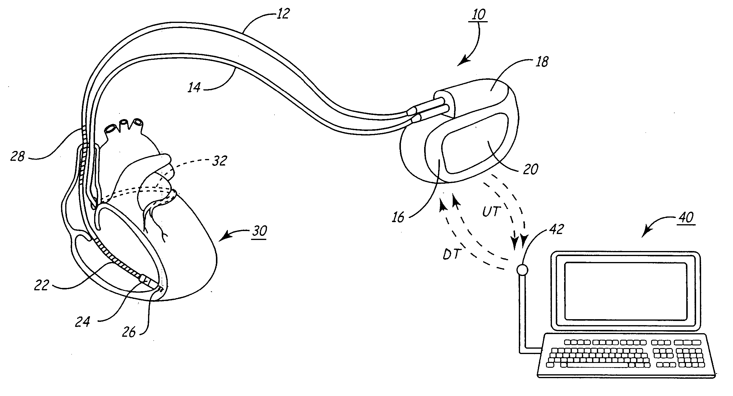 Inter-episode implementation of closed loop ATP