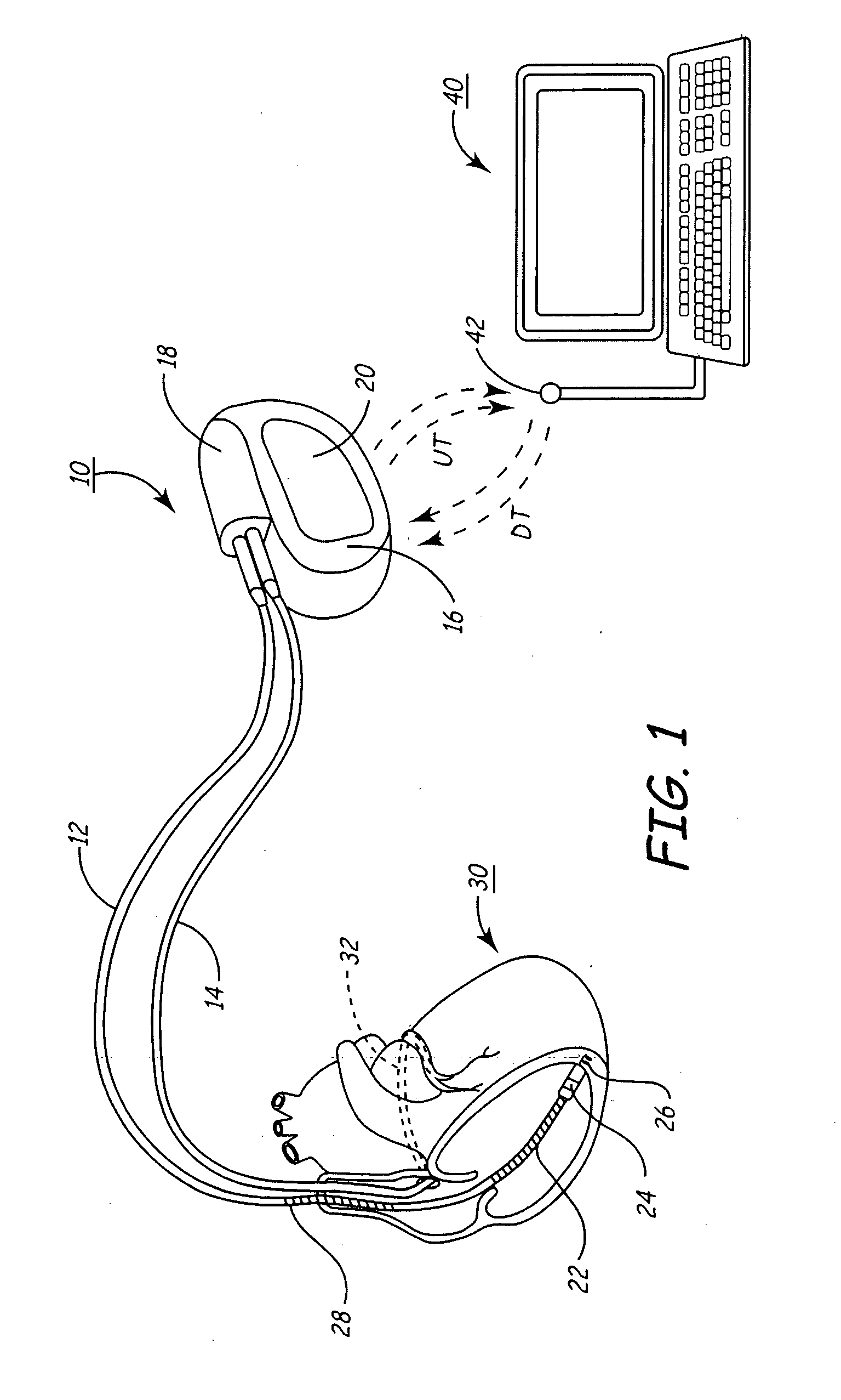 Inter-episode implementation of closed loop ATP