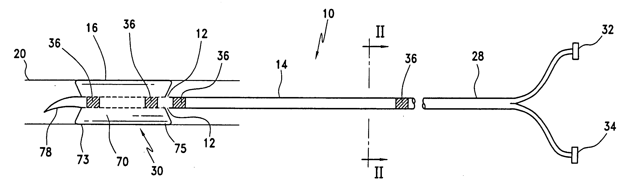 Method and apparatus for treatment of thrombosed hemodialysis access grafts