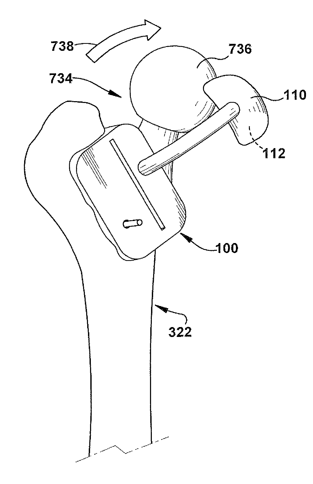 Positioning apparatus and method for a prosthetic implant