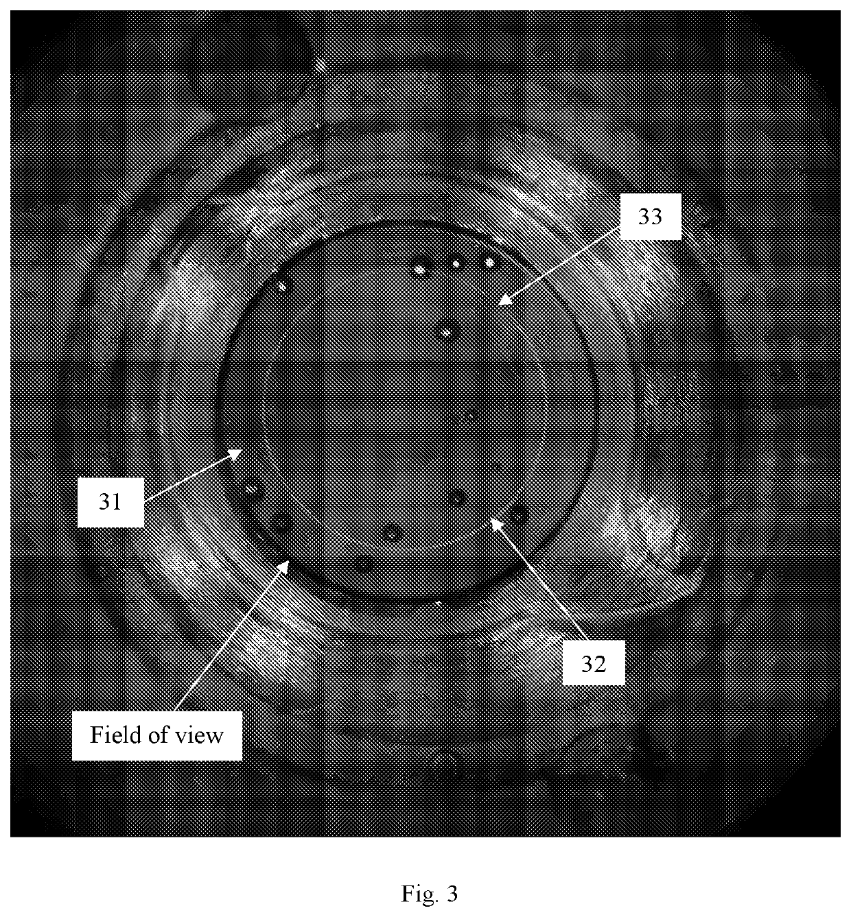 Process monitoring and control during laser-based refractive index modification of intraocular lenses in patients