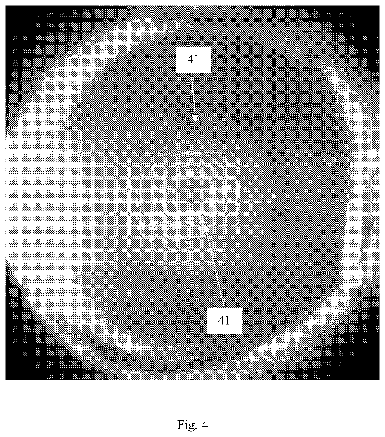 Process monitoring and control during laser-based refractive index modification of intraocular lenses in patients