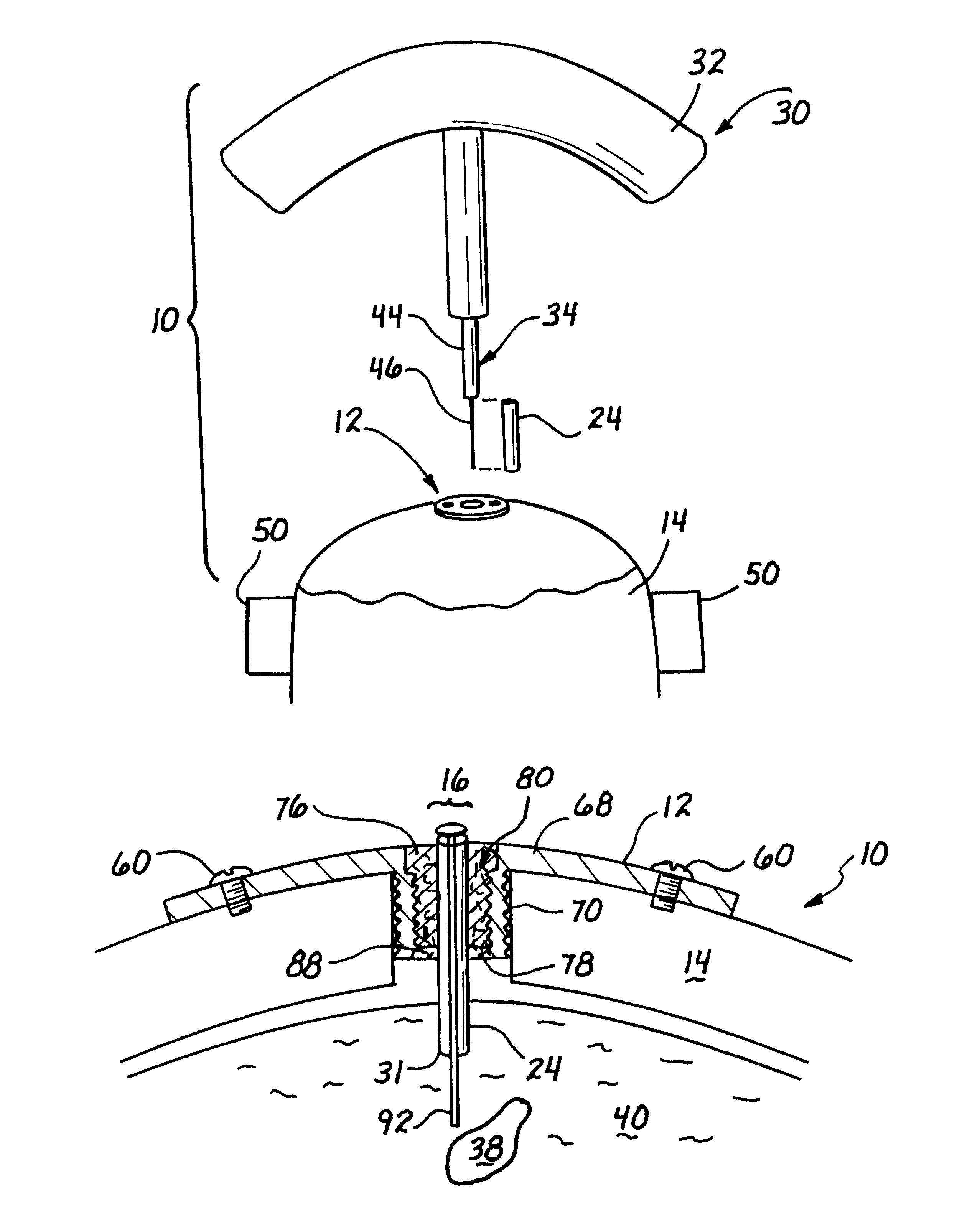 Stereotaxic detachable needle extension