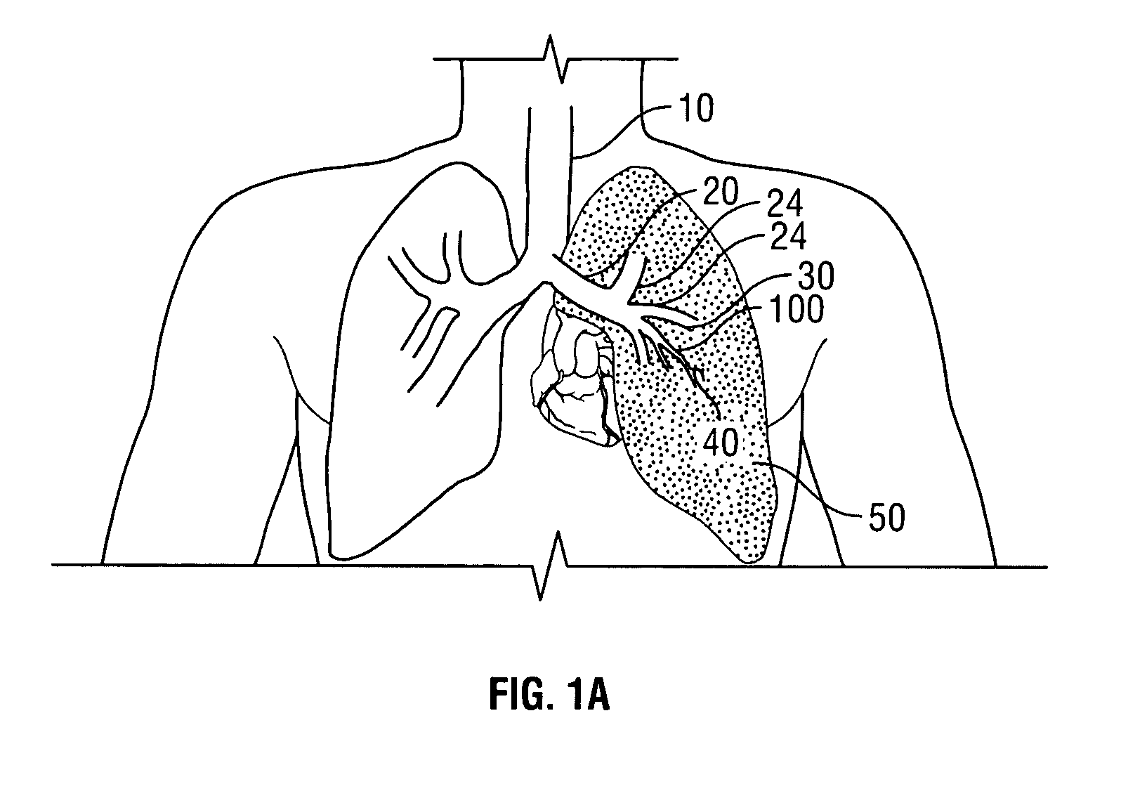 Extrapleural airway device and method